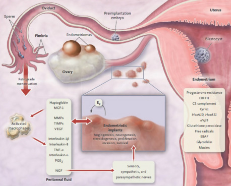 Infertility - Endometriosis World